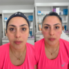 Relleno de Ojeras