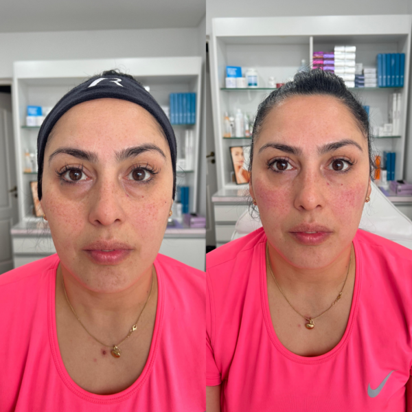 Relleno de Ojeras