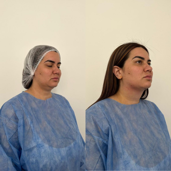 Lipoaspiración de Papada