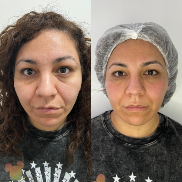 Relleno de Ojeras