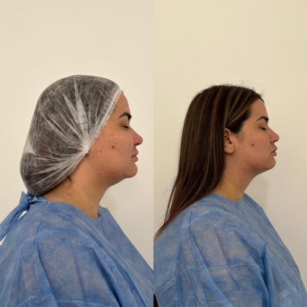 Lipoaspiración de Papada