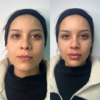 Armonización Facial