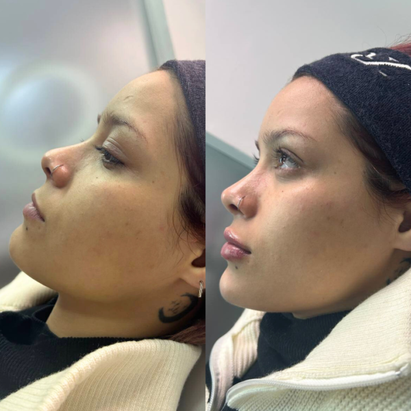 Armonización Facial