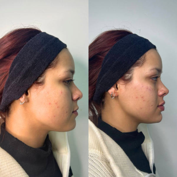 Armonización Facial