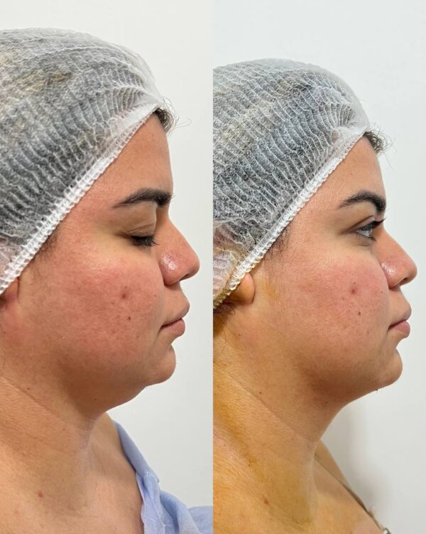 Lipoaspiración de Papada