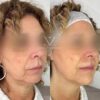 Armonización Facial