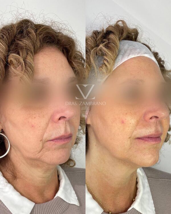 Armonización Facial