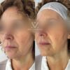 Armonización Facial