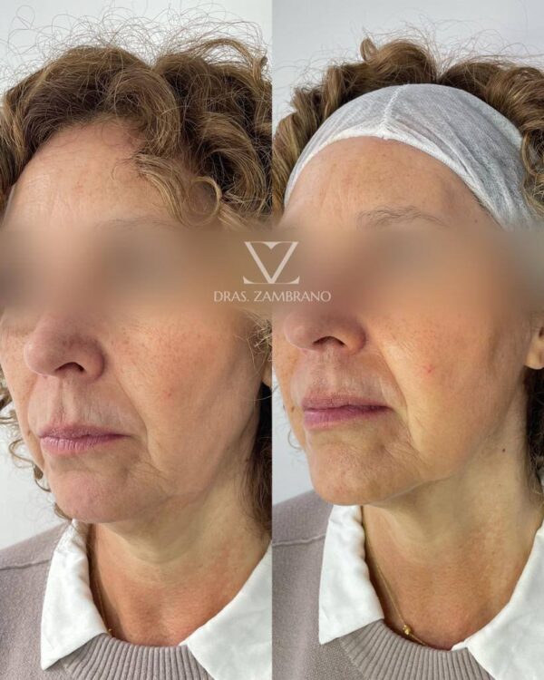 Armonización Facial