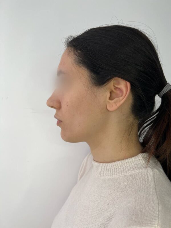 Contorno Mandibular