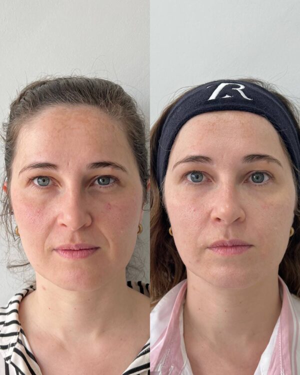 Armonización Facial