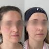 Armonización Facial