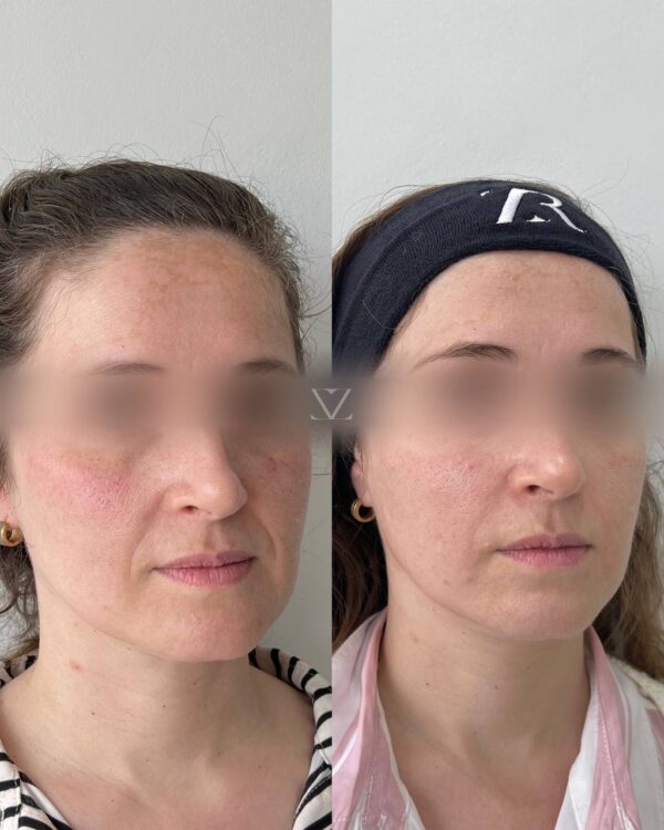 Armonización Facial