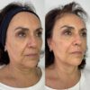 Armonización Facial