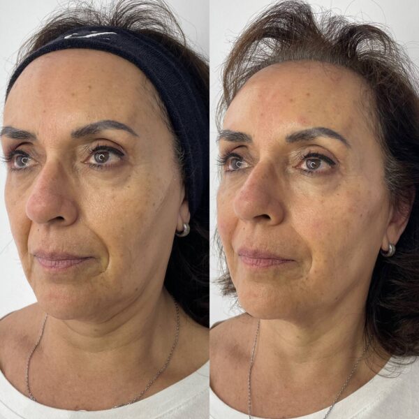 Armonización Facial