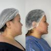 Lipoaspiración de Papada