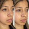 Relleno de Ojeras