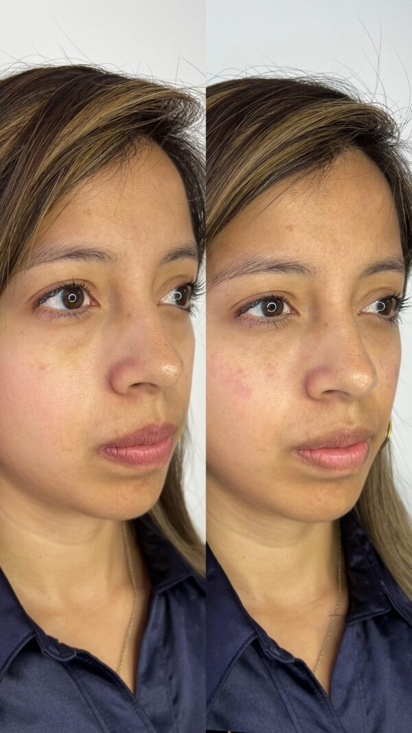Relleno de Ojeras