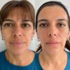 Relleno de Ojeras