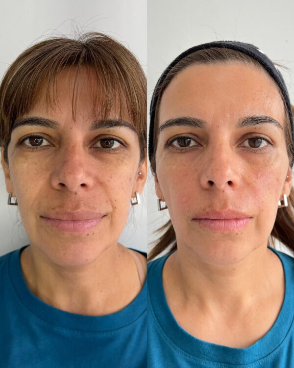 Relleno de Ojeras